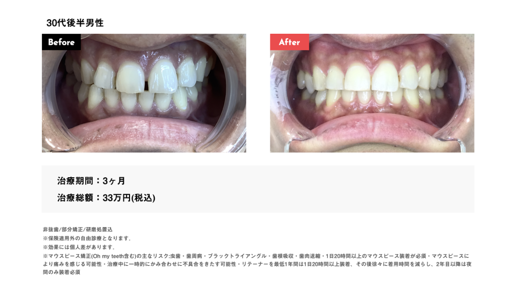 50代歯列矯正のビフォーアフター!これから始めるメリットとリスクを紹介 | 大人の矯正治療.com ~40代からの歯列矯正専門サイト~