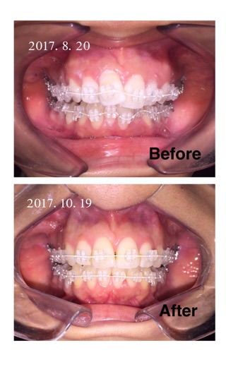矯正経過のご紹介 Esca Blog 名古屋駅すぐのエスカ歯科 矯正歯科
