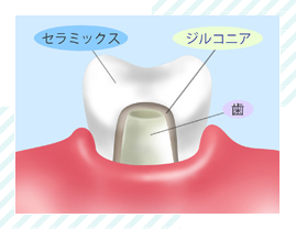 ジルコニアクラウン