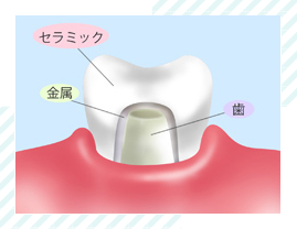 オールセラミッククラウン