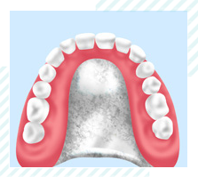 薄くて違和感が少ない～金属床義歯～