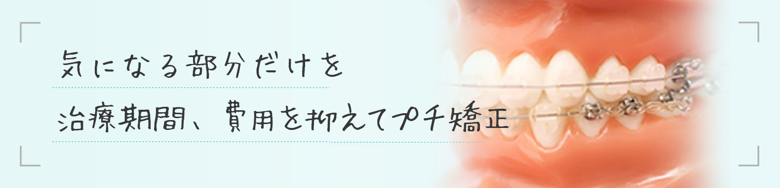 気になる部分だけを治療期間、費用を抑えてプチ矯正