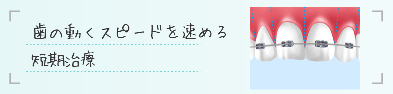 歯の動くスピードを速める短期治療