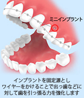 インプラントを固定源とし ワイヤーをかけることで出っ歯などに 対して歯を引っ張る力を強化します